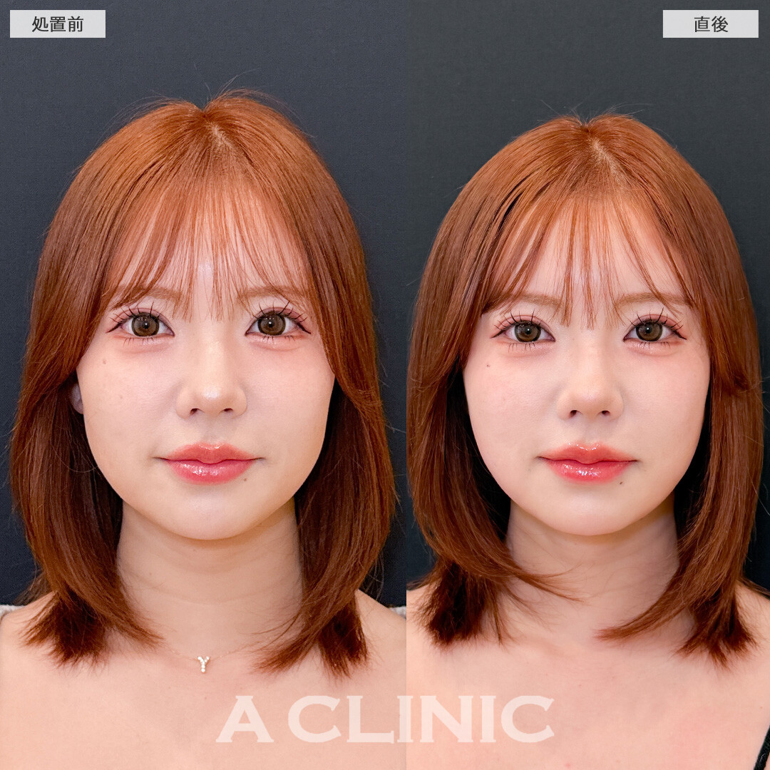 1day小顔脂肪吸引は直後からこんなに小顔になれる施術です！こちら処置前と直後の症例です(30代女性)