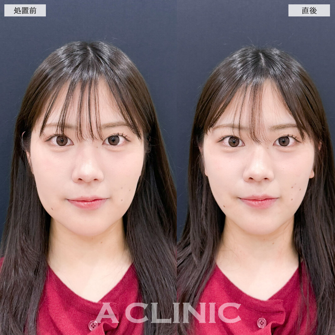 1day小顔脂肪吸引でお顔の左右差を整えながら即日小顔に！こちら処置前と直後の症例です(20代女性)
