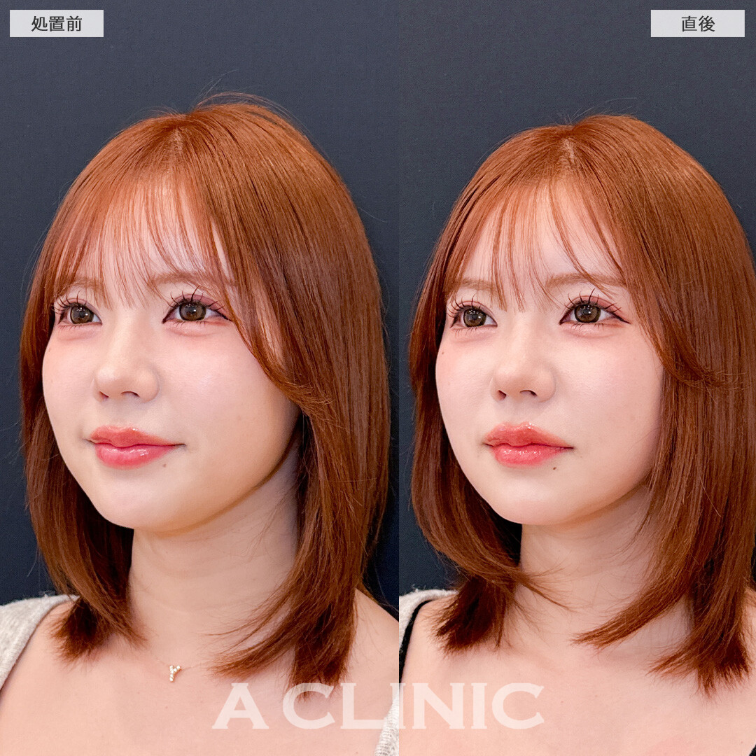 1day小顔脂肪吸引は直後からこんなに小顔になれる施術です！こちら処置前と直後の症例です(30代女性)