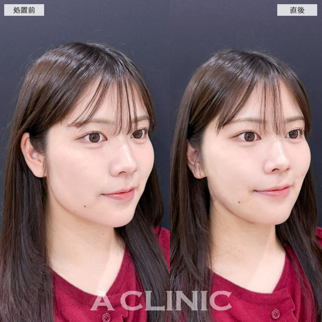 1day小顔脂肪吸引でお顔の左右差を整えながら即日小顔に！こちら処置前と直後の症例です(20代女性)