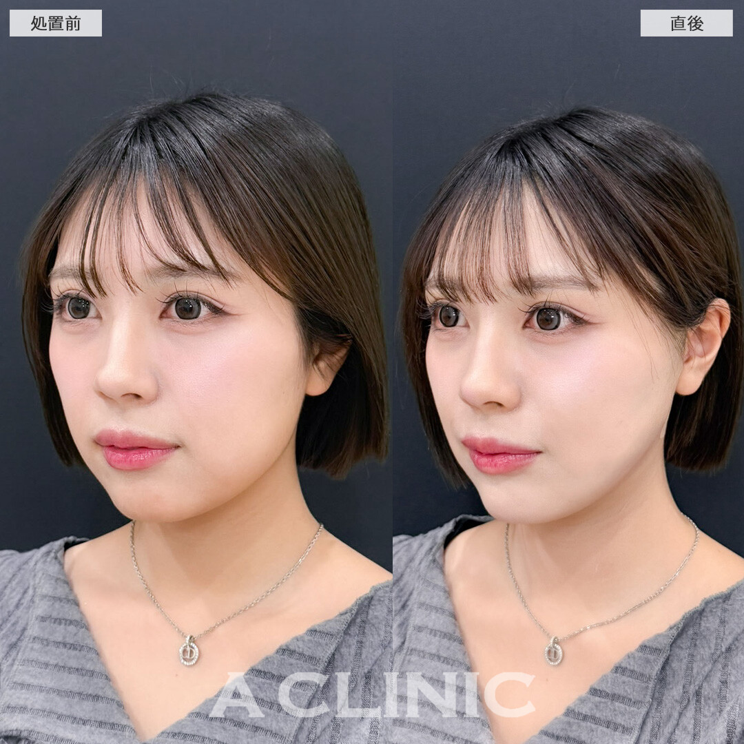 1day小顔脂肪吸引は直後から小顔を実感できます！こちら処置前と直後の症例です(20代女性)