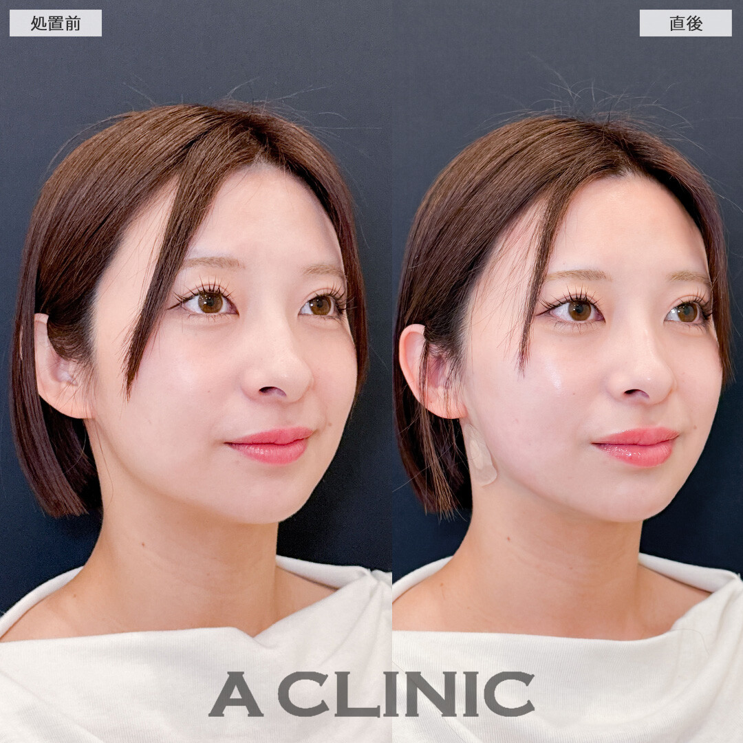 1day小顔脂肪吸引で余白のない小顔に！こちら処置前と直後の症例です(20代女性)