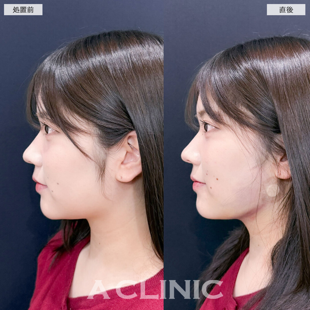 1day小顔脂肪吸引でお顔の左右差を整えながら即日小顔に！こちら処置前と直後の症例です(20代女性)