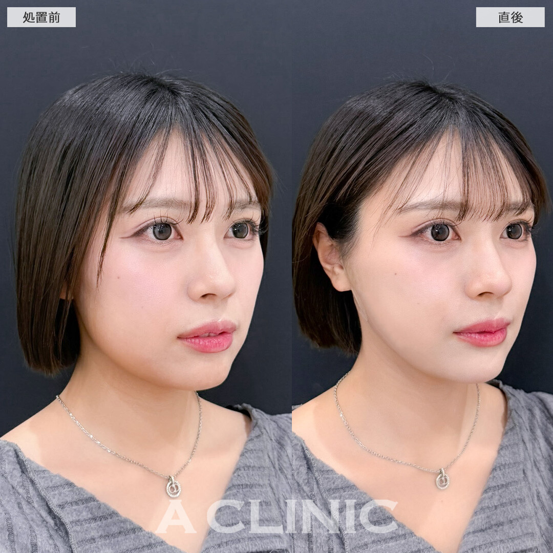 1day小顔脂肪吸引は直後から小顔を実感できます！こちら処置前と直後の症例です(20代女性)