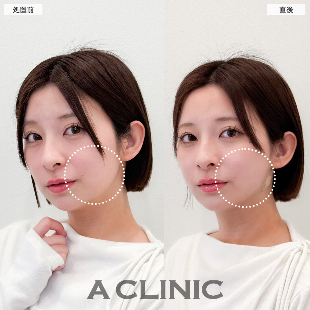 1day小顔脂肪吸引で余白のない小顔に！こちら処置前と直後の症例です(20代女性)