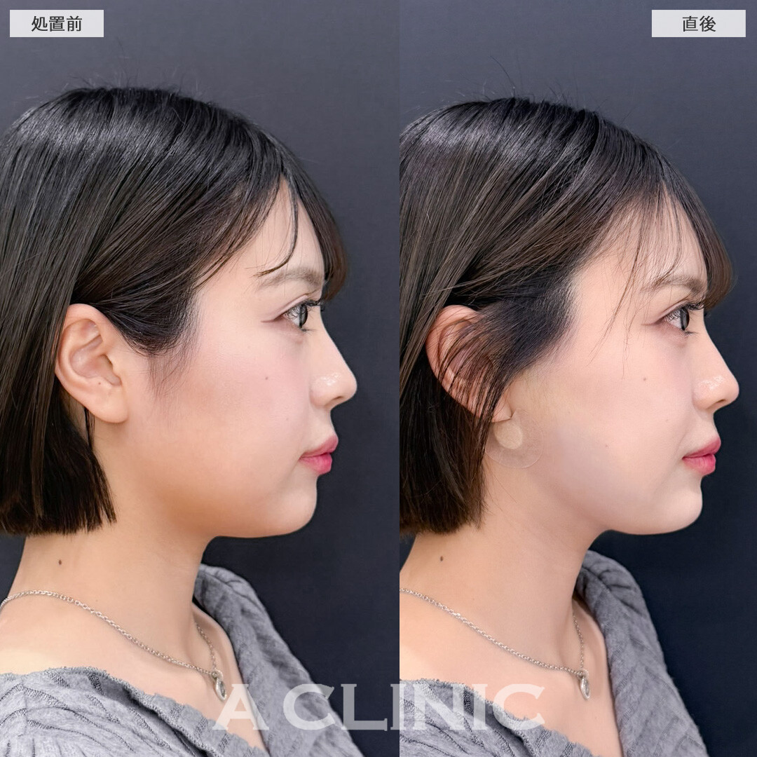 1day小顔脂肪吸引は直後から小顔を実感できます！こちら処置前と直後の症例です(20代女性)