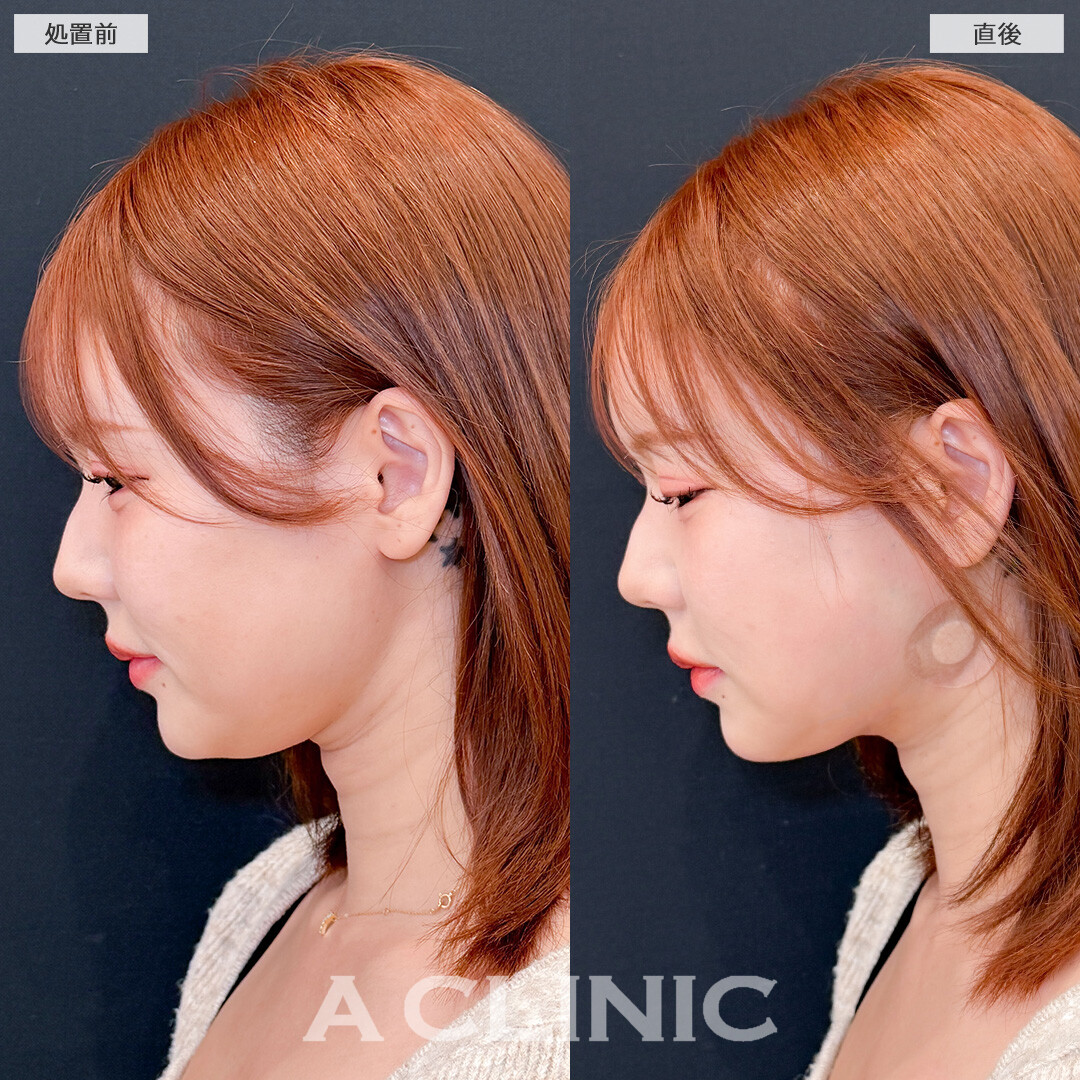 1day小顔脂肪吸引は直後からこんなに小顔になれる施術です！こちら処置前と直後の症例です(30代女性)