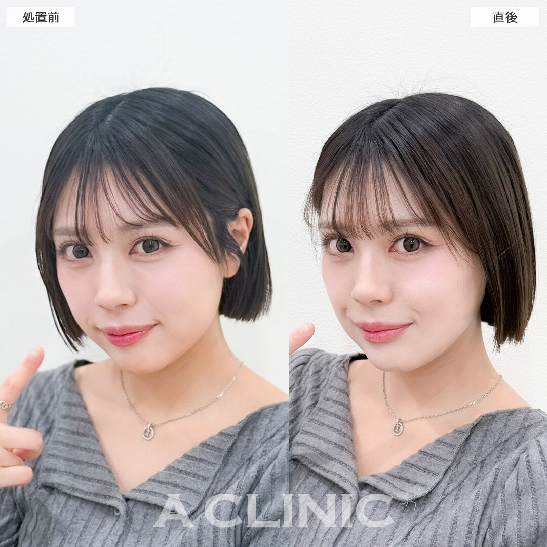 1day小顔脂肪吸引は直後から小顔を実感できます！こちら処置前と直後の症例です(20代女性)