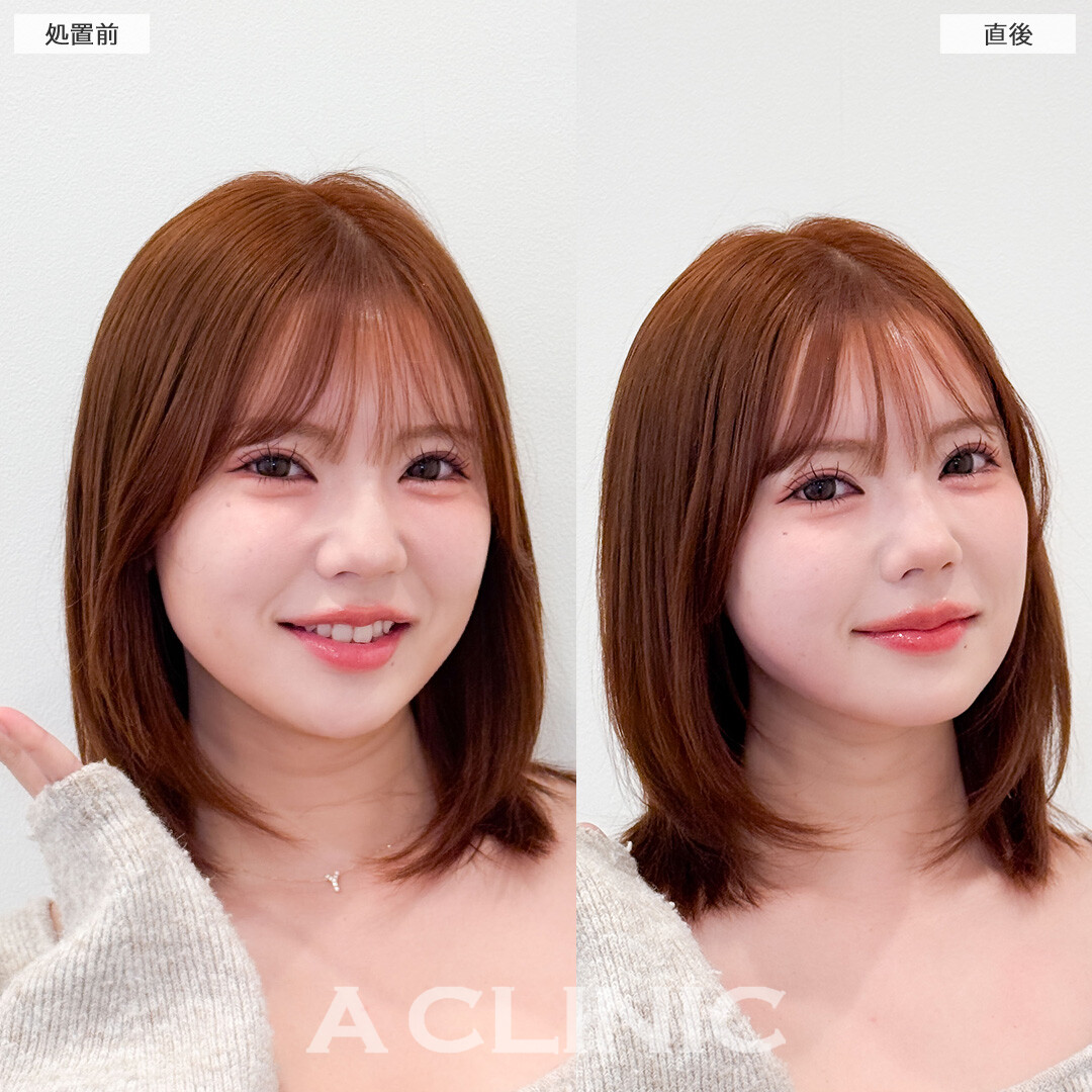 1day小顔脂肪吸引は直後からこんなに小顔になれる施術です！こちら処置前と直後の症例です(30代女性)