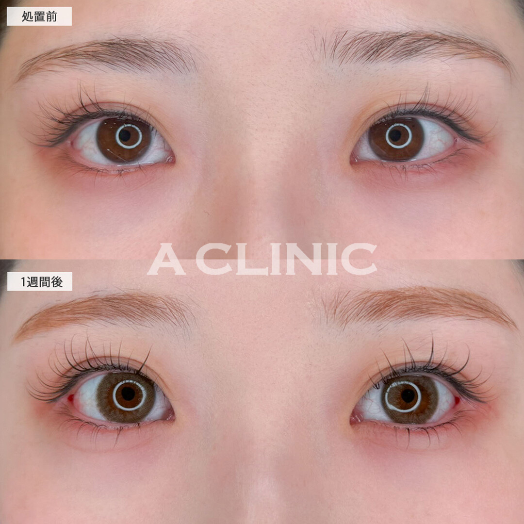 パーフェクトアイズでたれ目が叶いさらに可愛い目元になりました！こちら処置前と1週間後の症例です(20代女性)