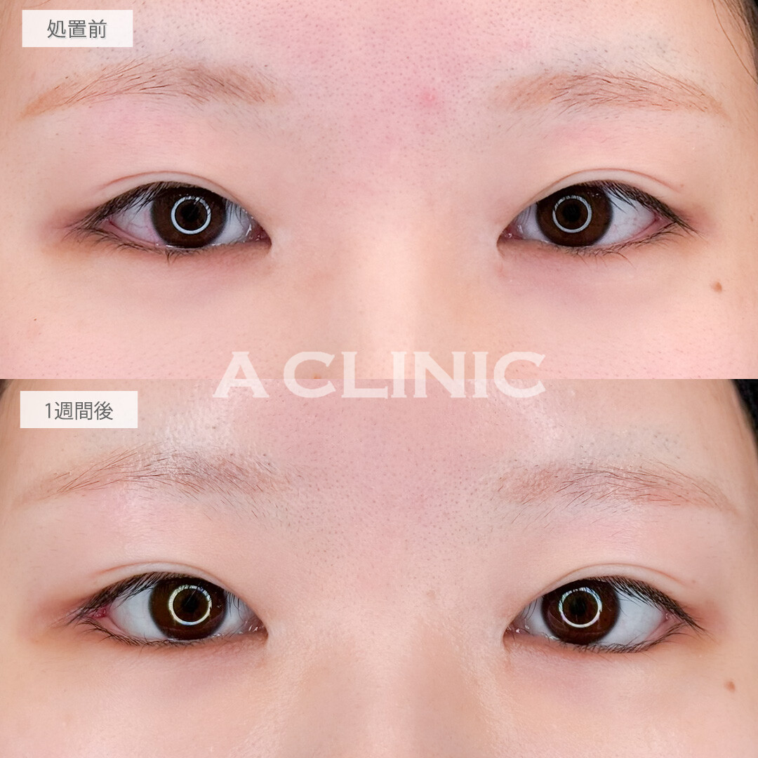 パーフェクトアイズで白目の範囲が広がり印象改善！処置前と1週間後の症例です(20代女性)