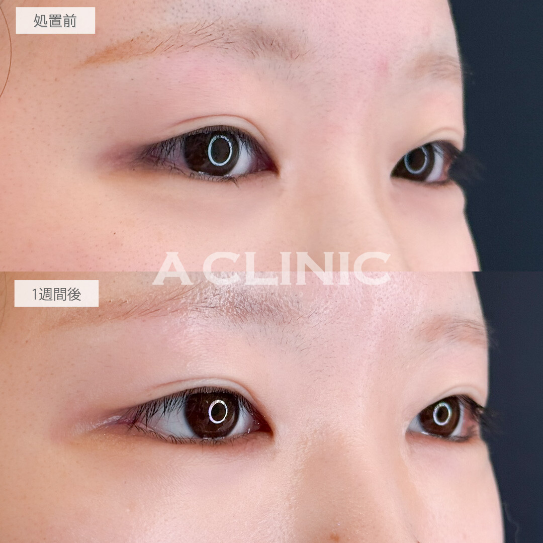 パーフェクトアイズで白目の範囲が広がり印象改善！処置前と1週間後の症例です(20代女性)