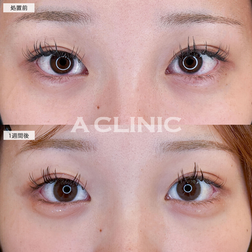 パーフェクトアイズで優しい印象の目元になりメイクもしやすくなります！こちら処置前と1週間後の症例です(10代女性)