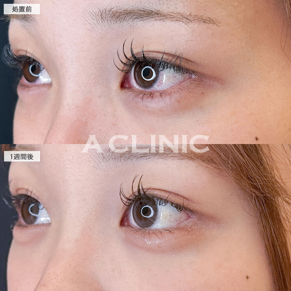 パーフェクトアイズで優しい印象の目元になりメイクもしやすくなります！こちら処置前と1週間後の症例です(10代女性)