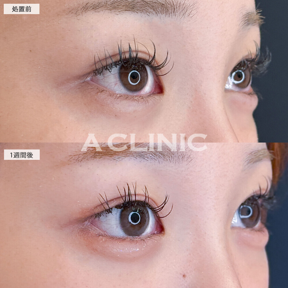 パーフェクトアイズで優しい印象の目元になりメイクもしやすくなります！こちら処置前と1週間後の症例です(10代女性)