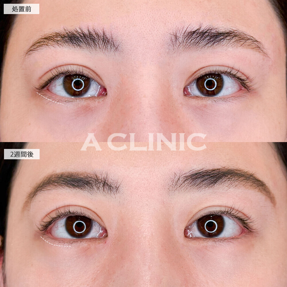 パーフェクトアイズで整形感なくナチュラルにツリ目改善！こちら処置前と2週間後の症例です(20代女性)