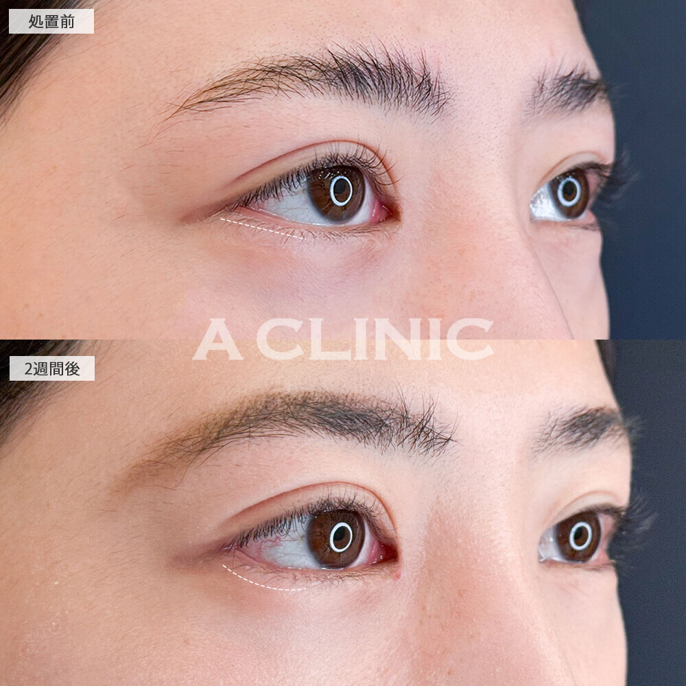 パーフェクトアイズで整形感なくナチュラルにツリ目改善！こちら処置前と2週間後の症例です(20代女性)