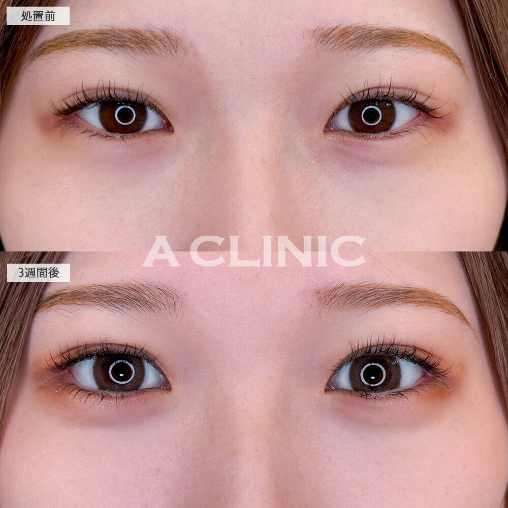 パーフェクトアイズで吊ってる印象から優しい目元に！こちら処置前と3週間後の症例です(20代女性)