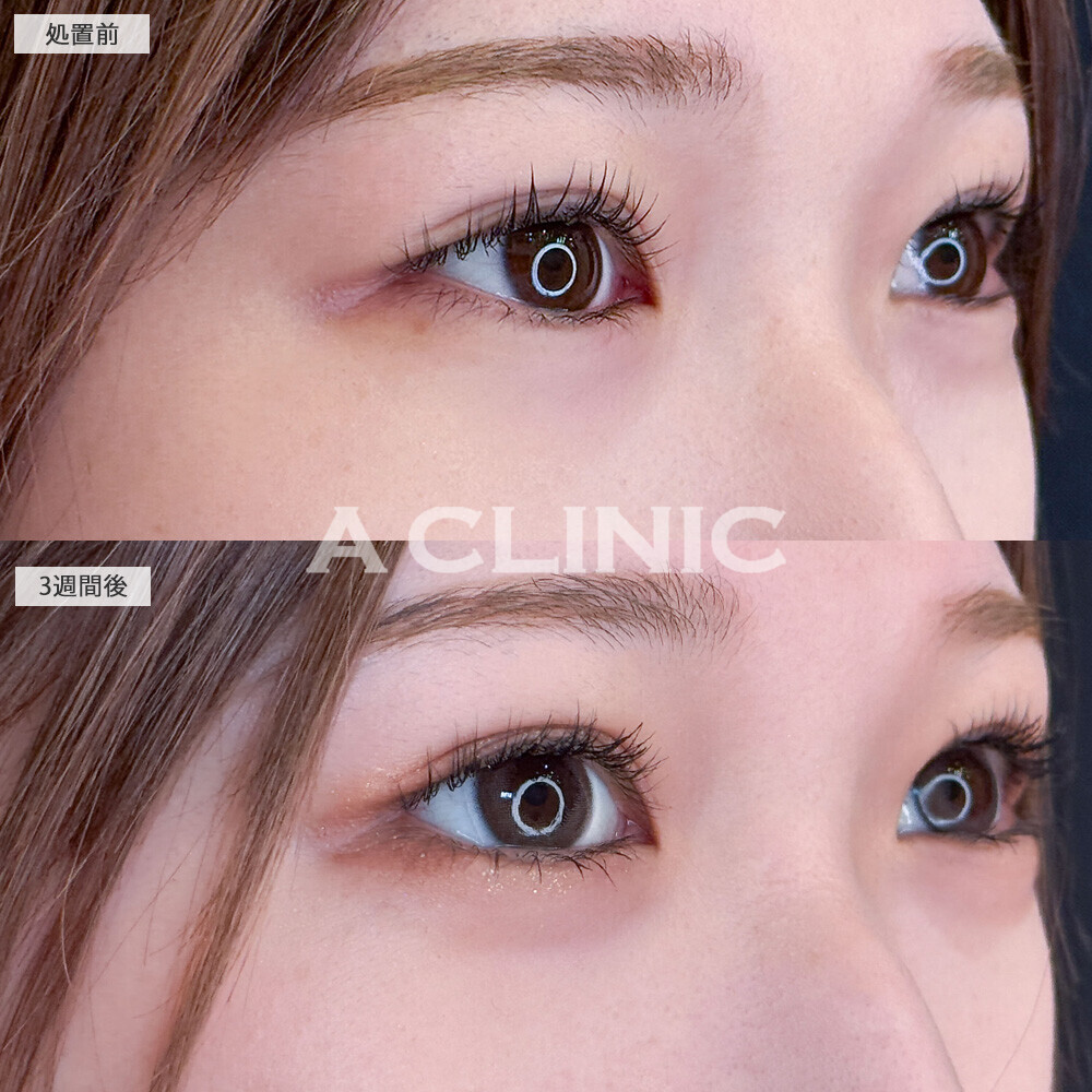 パーフェクトアイズで吊ってる印象から優しい目元に！こちら処置前と3週間後の症例です(20代女性)