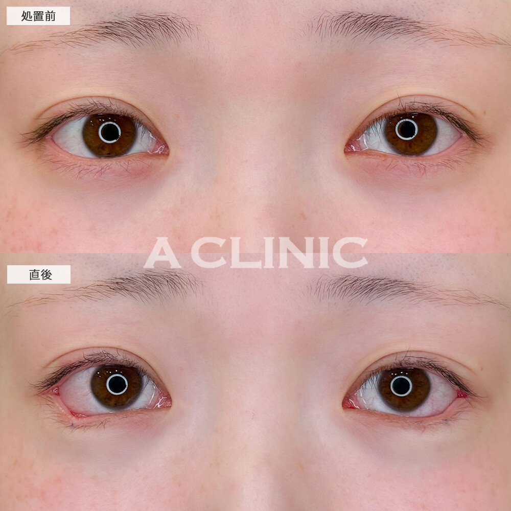 パーフェクトアイズで目力が増してデカ目に！こちら処置前と処置直後の症例です(20代女性)