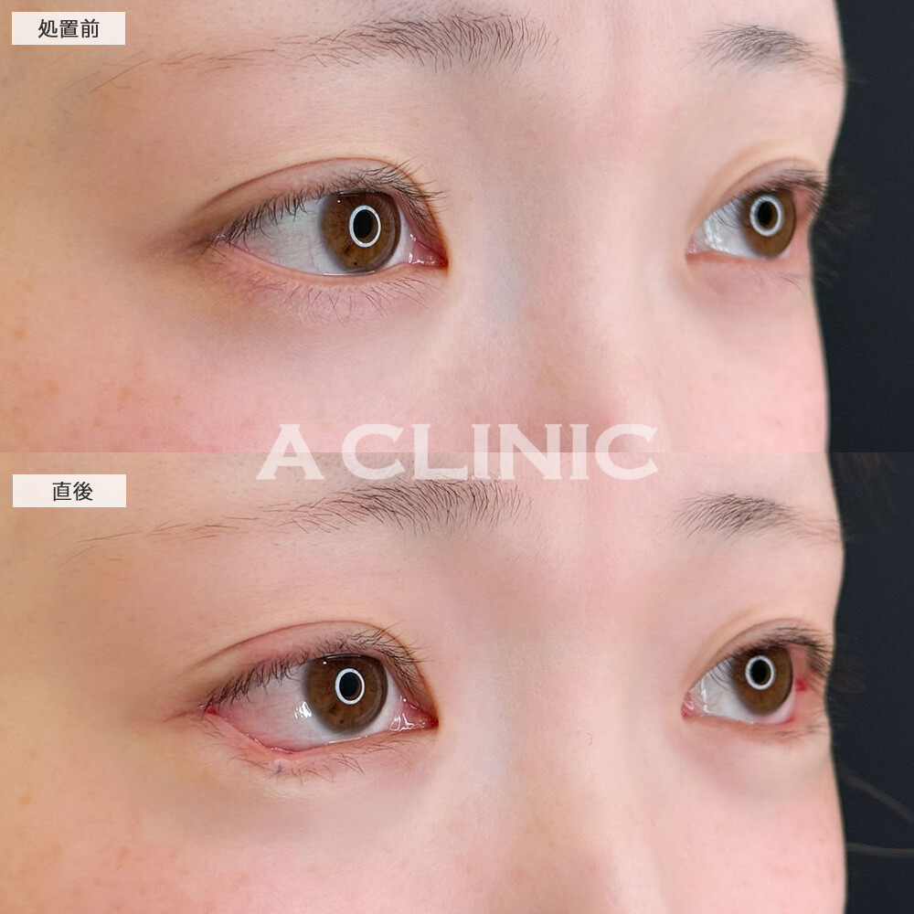 パーフェクトアイズで目力が増してデカ目に！こちら処置前と処置直後の症例です(20代女性)