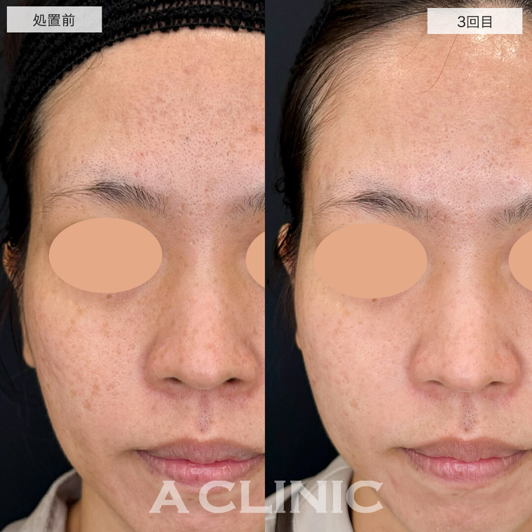 ポテンツァとケミカルピーリングで額と頬のニキビ跡が改善しました!こちら処置前と3回目の症例です(30代女性)
