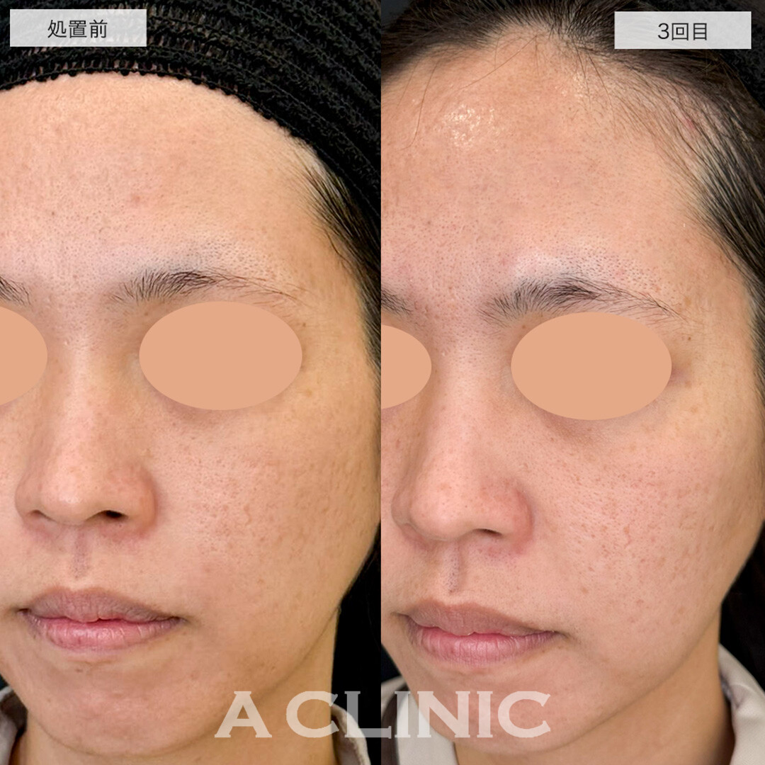 ポテンツァとケミカルピーリングで額と頬のニキビ跡が改善しました!こちら処置前と3回目の症例です(30代女性)