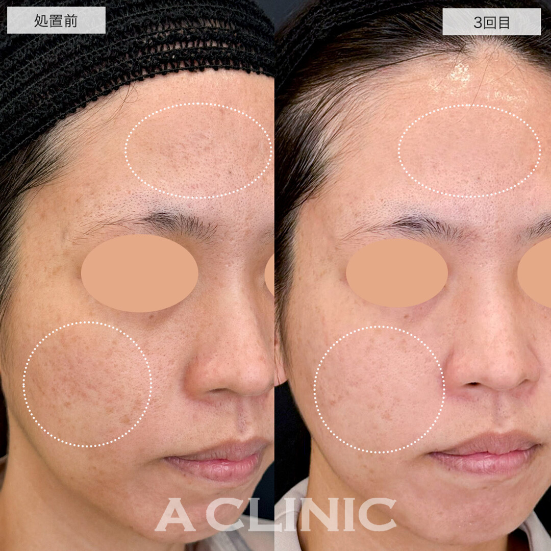 ポテンツァとケミカルピーリングで額と頬のニキビ跡が改善しました!こちら処置前と3回目の症例です(30代女性)