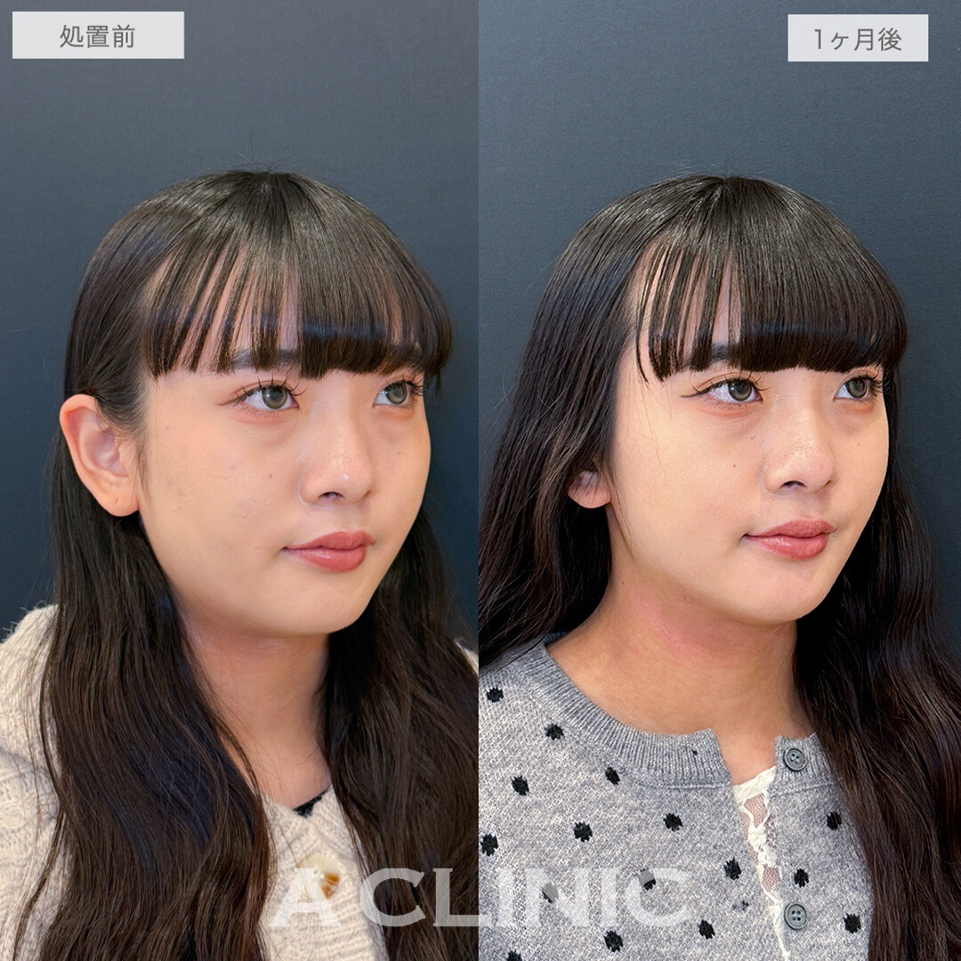 1day小顔脂肪吸引と小顔エラボトックスで周りから褒められる究極の小顔が手に入りました！処置前と1ヶ月後の症例です(20代女性)