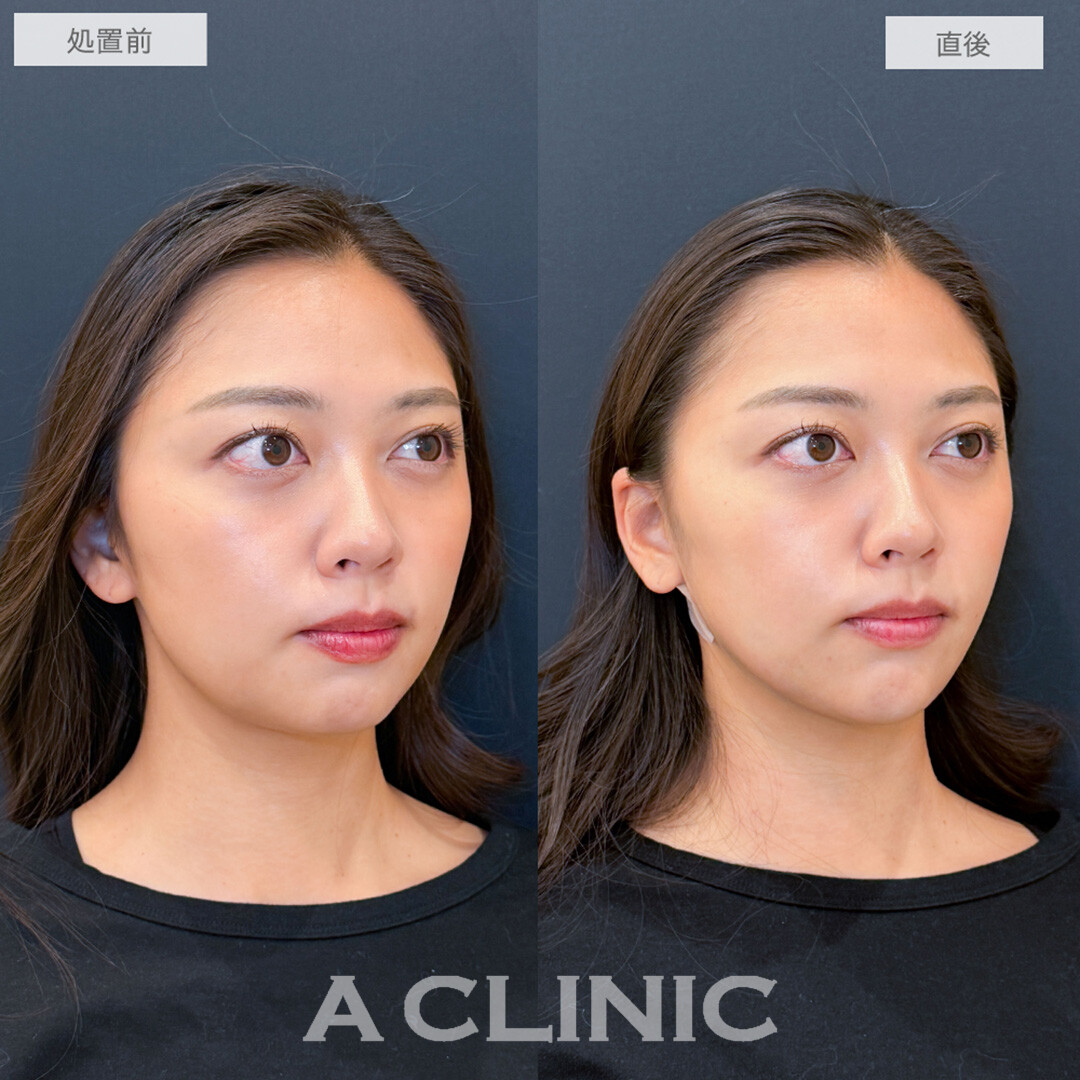 1day小顔脂肪吸引とあごへのヒアルロン酸注入でフェイスラインのもたつきが一気に引き上がる！処置前と直後の症例です(20代女性)