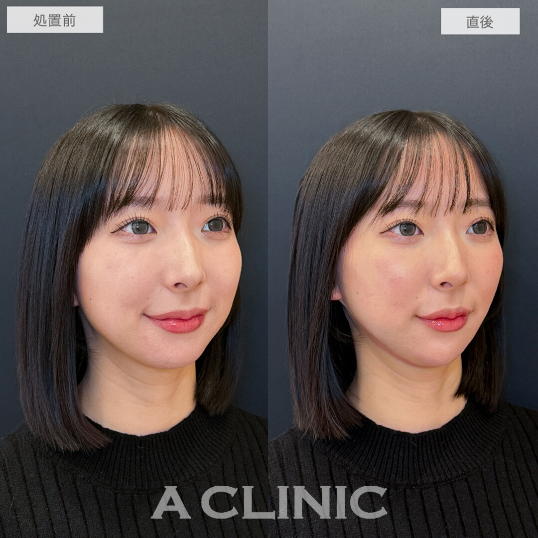 1day小顔脂肪吸引とあごへのヒアルロン酸注入で直後から憧れのVフェイスに！処置前と直後の症例です(20代女性)