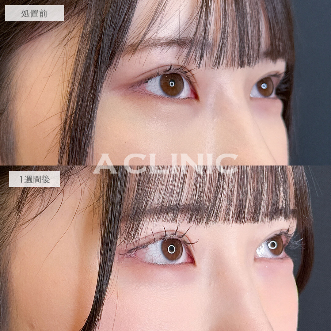 パーフェクトアイズで左右差と面長な印象が改善されました！処置前と1週間後の症例です(20代女性)