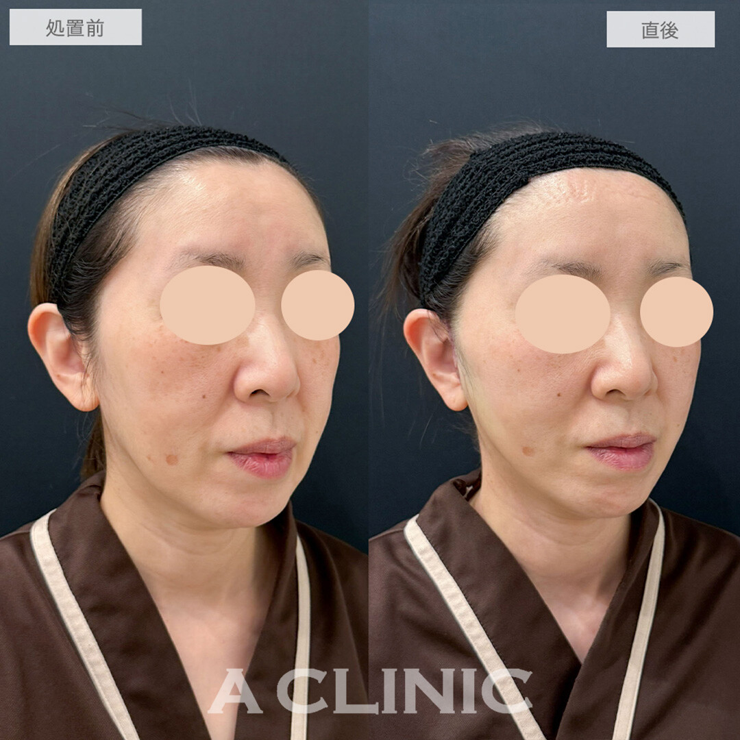 A式美肌たるみ切開でブルドッグ顔から綺麗なV字の輪郭に！処置前と直後の症例です(50代女性)