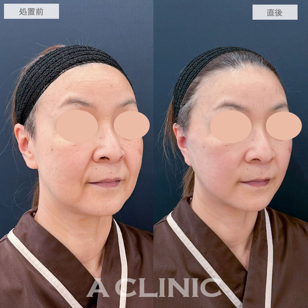 A式美肌たるみ切開で直後からほうれい線がなくなりたるみのない若々しいお顔に！処置前と直後の症例です(50代女性)