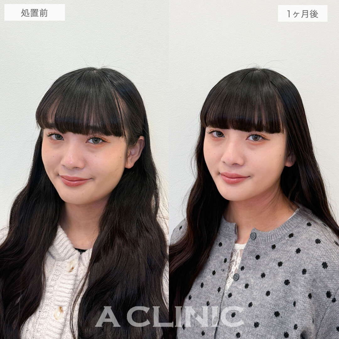 1day小顔脂肪吸引と小顔エラボトックスで周りから褒められる究極の小顔が手に入りました！処置前と1ヶ月後の症例です(20代女性)