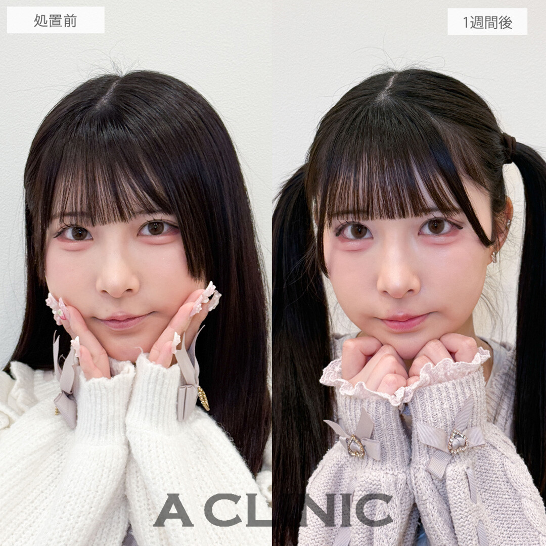 パーフェクトアイズで左右差と面長な印象が改善されました！処置前と1週間後の症例です(20代女性)