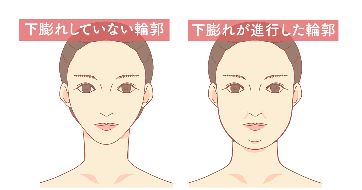 下膨れの状態を説明