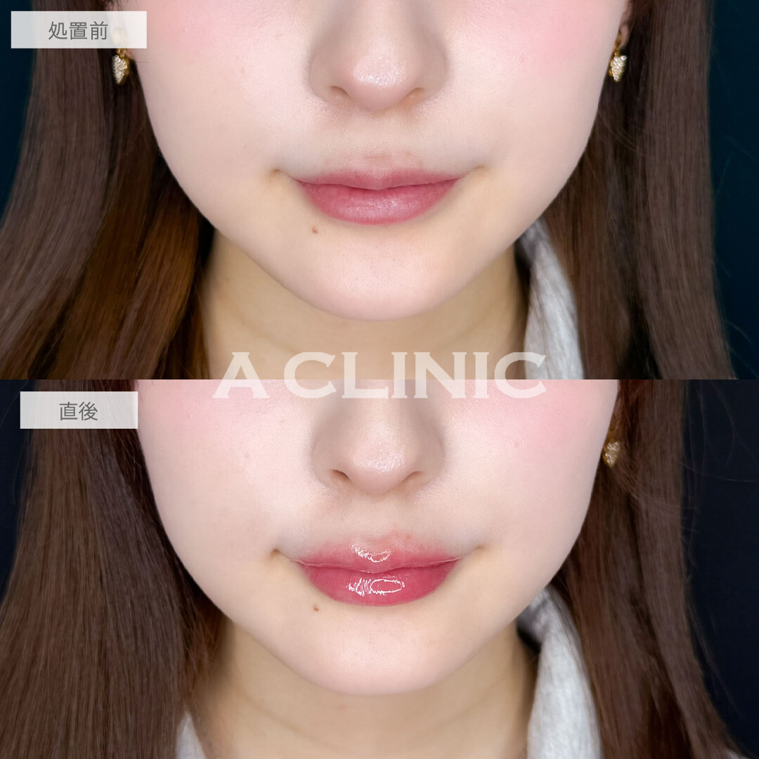スマイルリップで唇の左右差なくして可愛くボリュームアップ！こちら処置前と直後の症例です(20代女性)