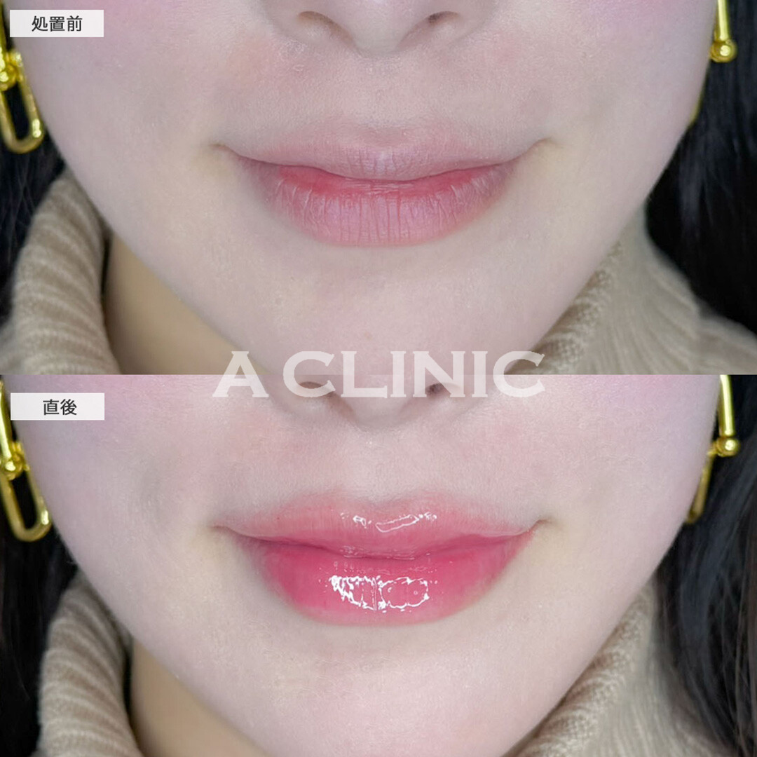 スマイルリップで唇にボリュームを出し更に可愛くアップデート！こちら処置前と直後の症例です(30代女性)