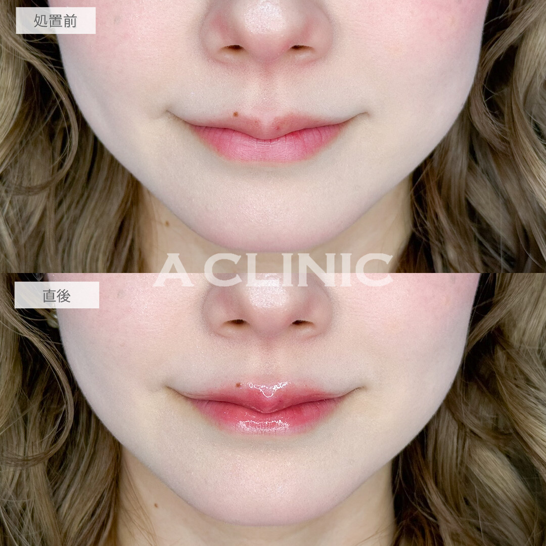 スマイルリップでボリュームを出しすぎずにさりげなく人中短縮が叶いました！処置前と直後の症例です(30代女性)