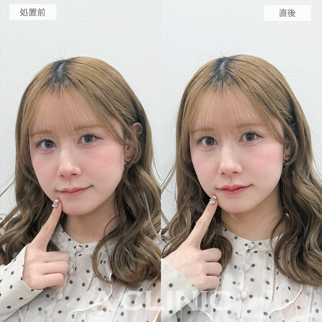 スマイルリップでボリュームを出しすぎずにさりげなく人中短縮が叶いました！処置前と直後の症例です(30代女性)