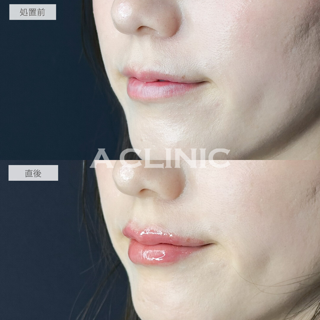 スマイルリップで自分に似合う形や厚みを提案してもらえました！処置前と直後の症例です(30代女性)