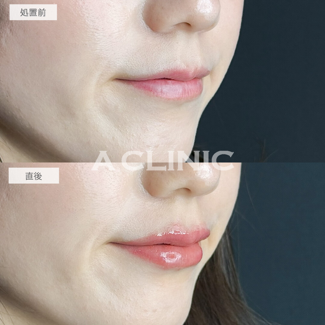 スマイルリップで自分に似合う形や厚みを提案してもらえました！処置前と直後の症例です(30代女性)