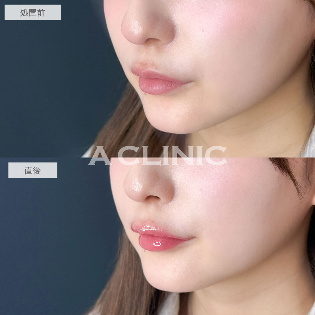 スマイルリップで唇の左右差なくして可愛くボリュームアップ！こちら処置前と直後の症例です(20代女性)