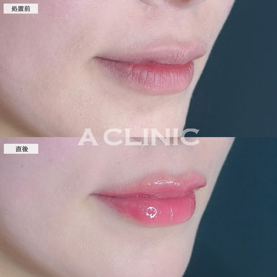 スマイルリップで唇にボリュームを出し更に可愛くアップデート！こちら処置前と直後の症例です(30代女性)