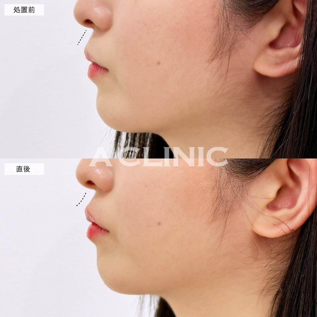 スマイルリップで唇のボリュームが出て人中短縮効果も！処置前と直後の症例です(20代女性)