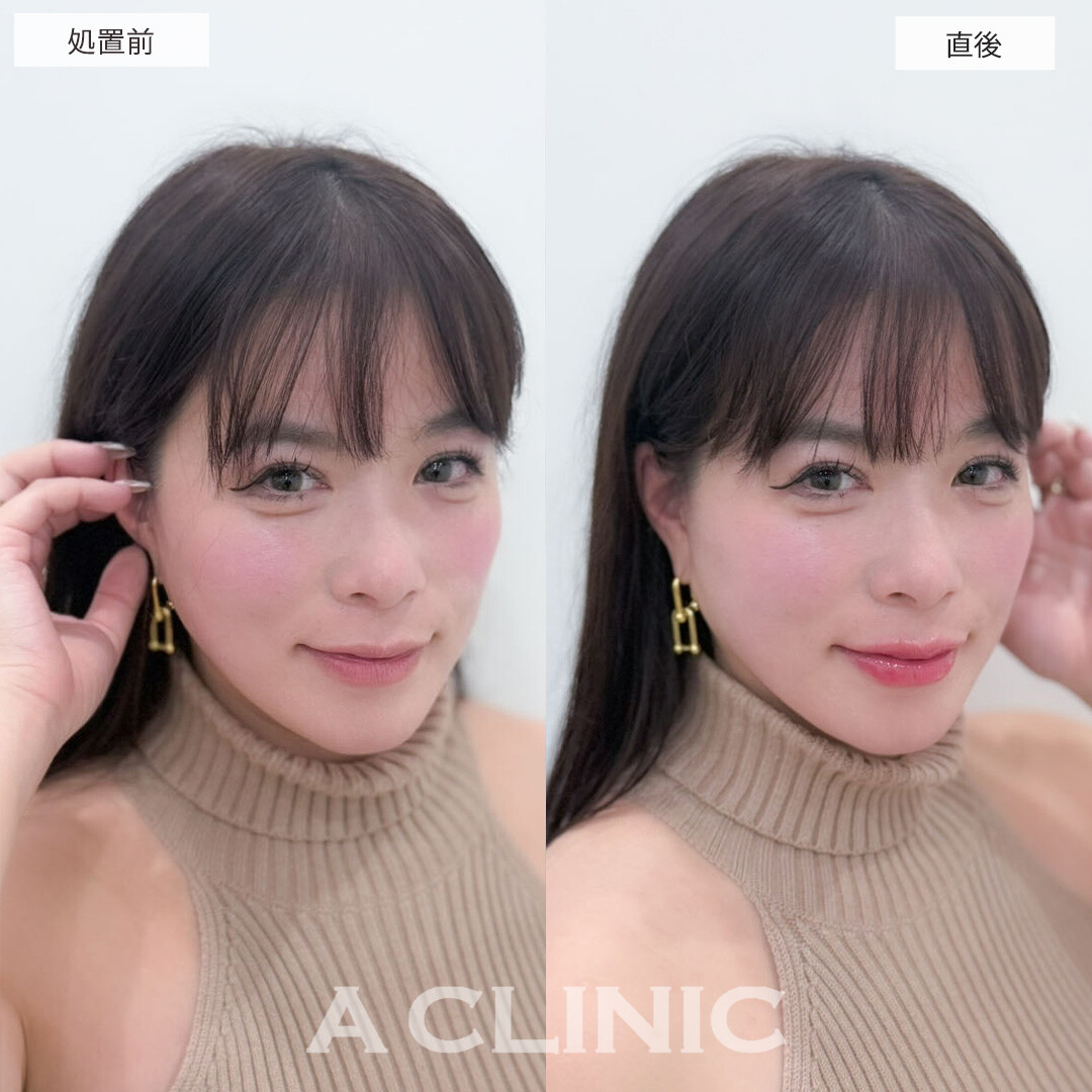 スマイルリップで唇にボリュームを出し更に可愛くアップデート！こちら処置前と直後の症例です(30代女性)