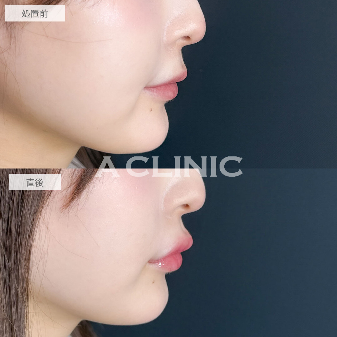 スマイルリップで唇の左右差なくして可愛くボリュームアップ！こちら処置前と直後の症例です(20代女性)