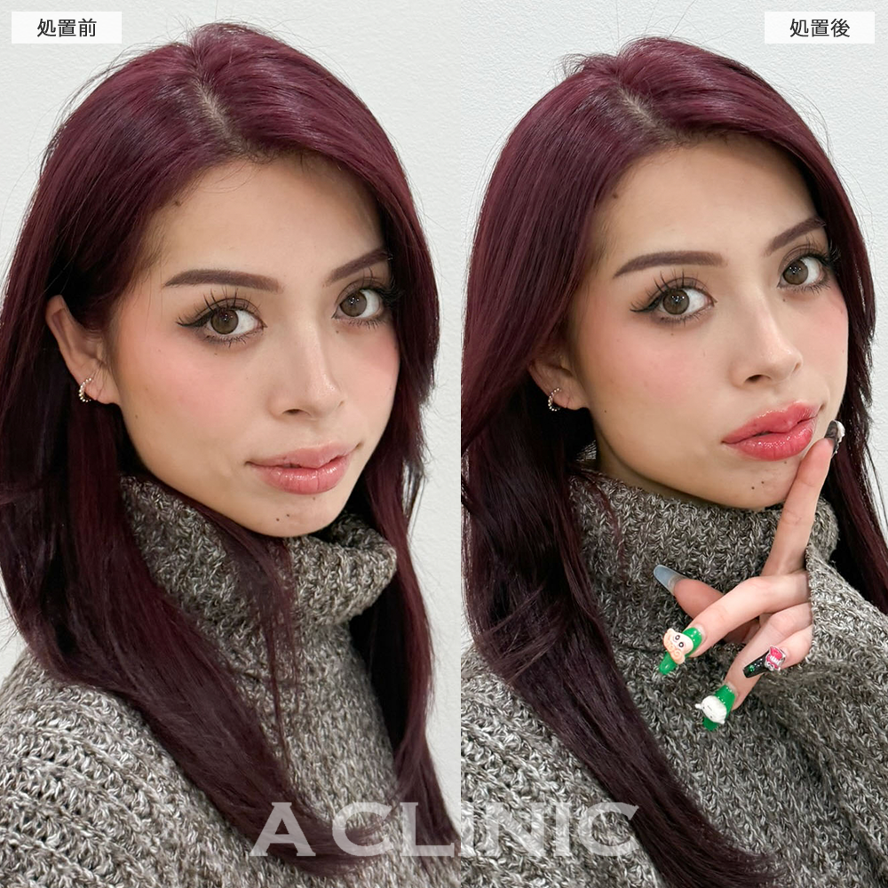 スマイルリップでぷっくりした存在感のある唇に変化！こちら施術前と直後の症例です(20代女性)