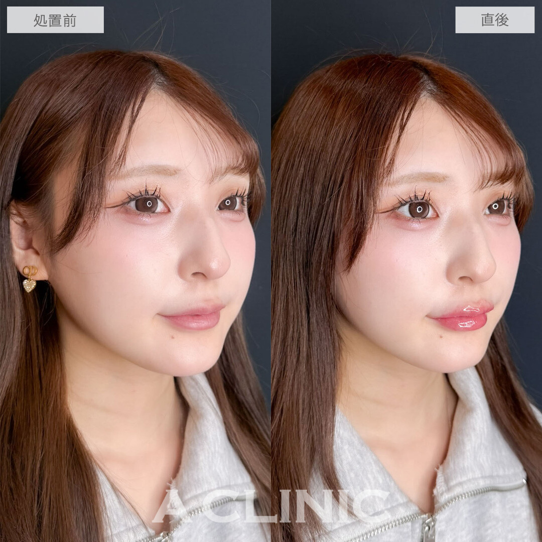 スマイルリップで唇の左右差なくして可愛くボリュームアップ！こちら処置前と直後の症例です(20代女性)